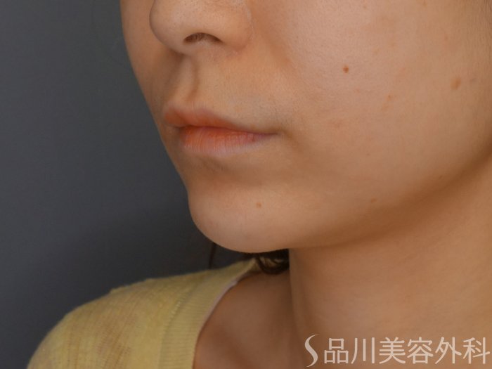 症例NO.70473のAFTER写真