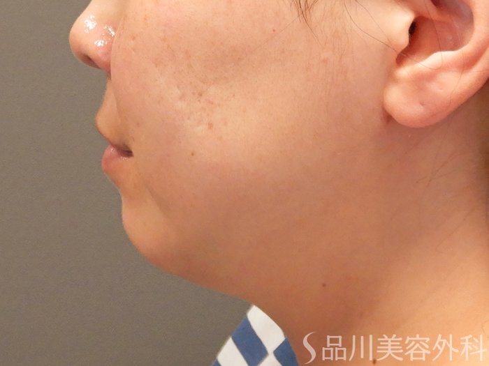 症例NO.69356のAFTER写真