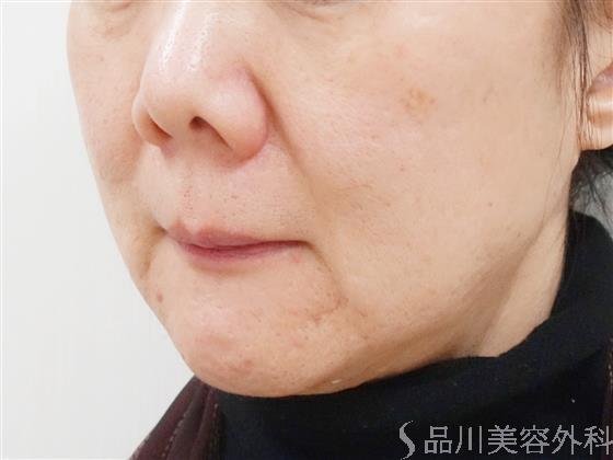 症例NO.39102のBEFORE写真