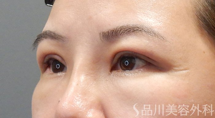 症例NO.71525のAFTER写真