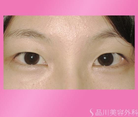 症例NO.816のBEFORE写真