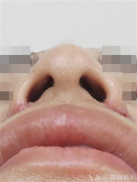 症例NO.40704のAFTER写真
