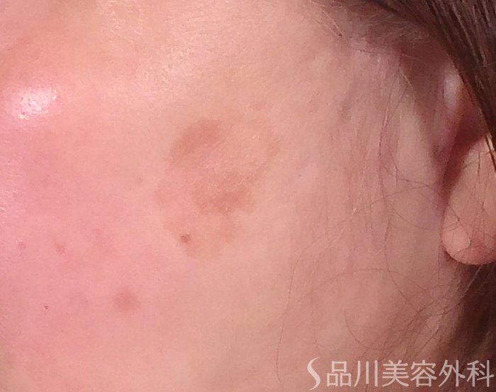 症例NO.70321のBEFORE写真