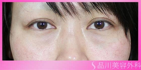 症例NO.54394のBEFORE写真
