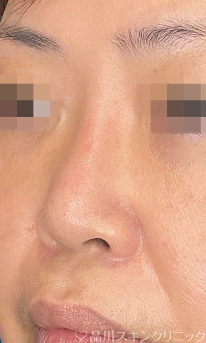 症例NO.75091のAFTER写真