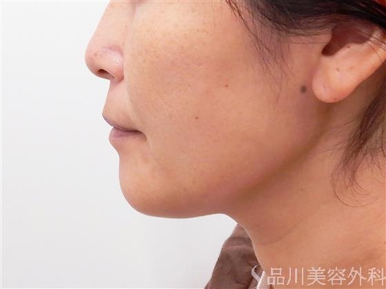 症例NO.61950のBEFORE写真