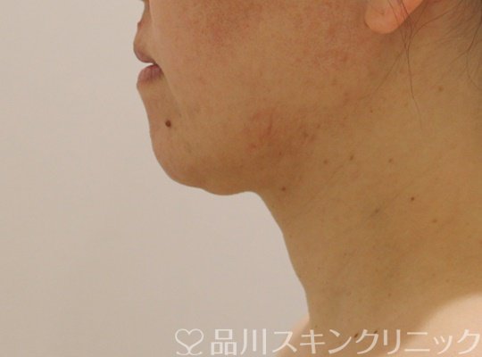 症例NO.73295のAFTER写真