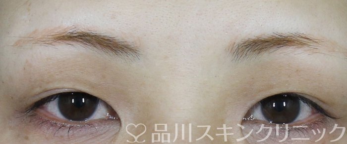 症例NO.70142のBEFORE写真