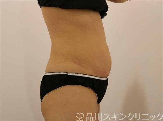 症例NO.44478のBEFORE写真