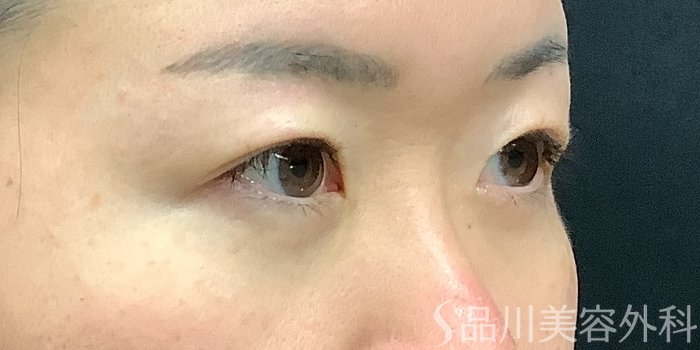 症例NO.71247のBEFORE写真
