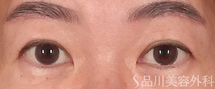 症例NO.70394のAFTER写真