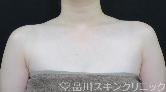 症例NO.70123のAFTER写真