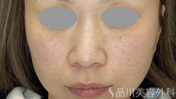 症例NO.74380のBEFORE写真