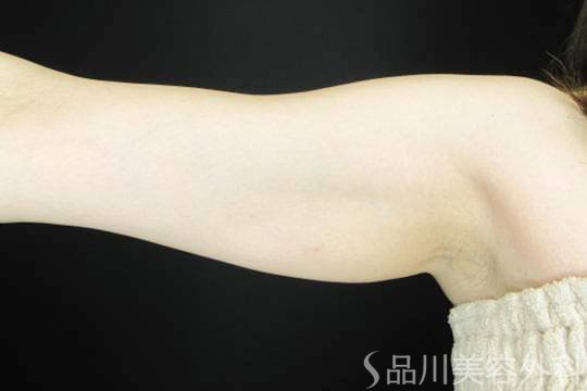 症例NO.74913のBEFORE写真