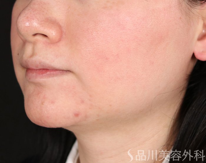 症例NO.73956のBEFORE写真