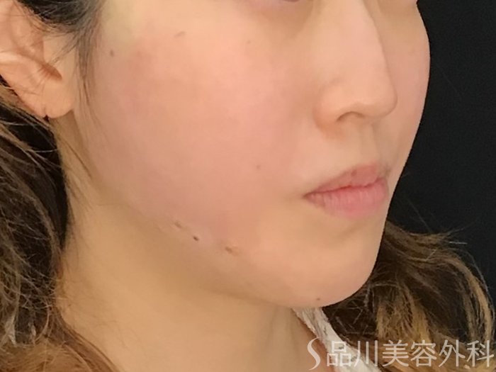 症例NO.71553のAFTER写真