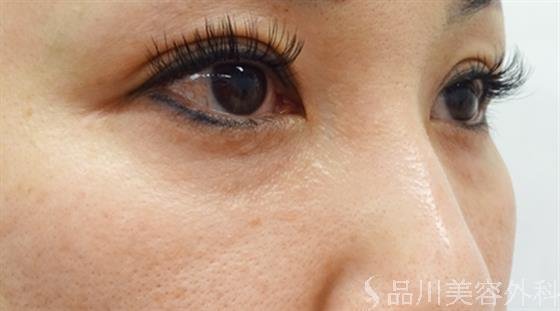 症例NO.40665のBEFORE写真