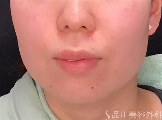 症例NO.59606のBEFORE写真