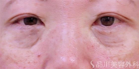 症例NO.45824のAFTER写真