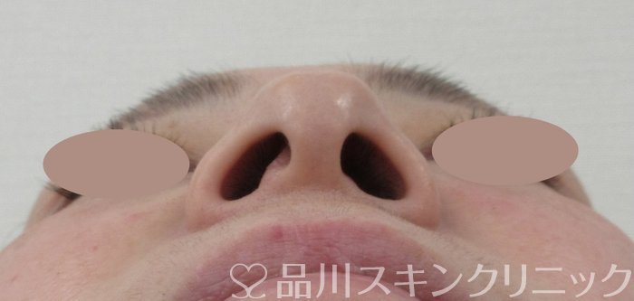 症例NO.63733のBEFORE写真