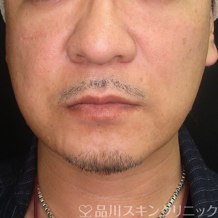症例NO.69132のBEFORE写真