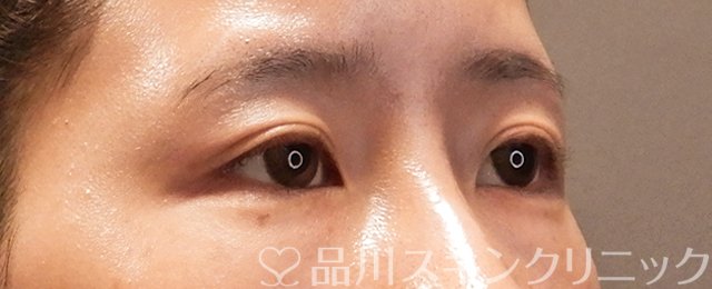 症例NO.70551のBEFORE写真