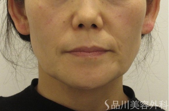 症例NO.72707のAFTER写真