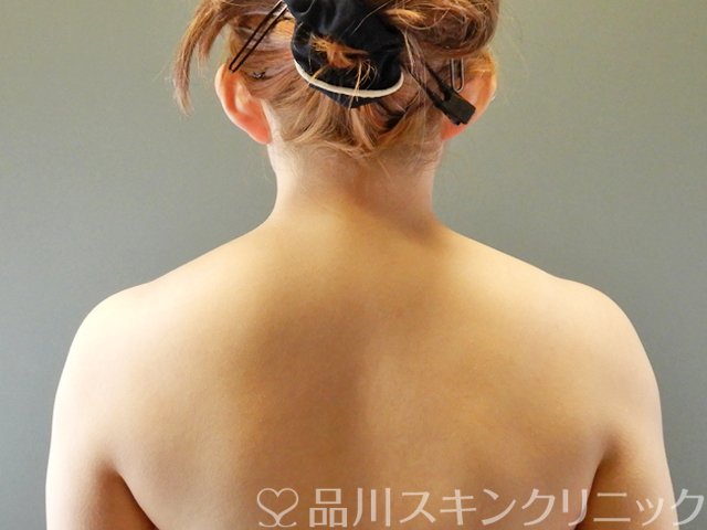 症例NO.64632のBEFORE写真