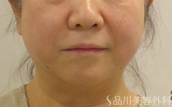 症例NO.63960のAFTER写真