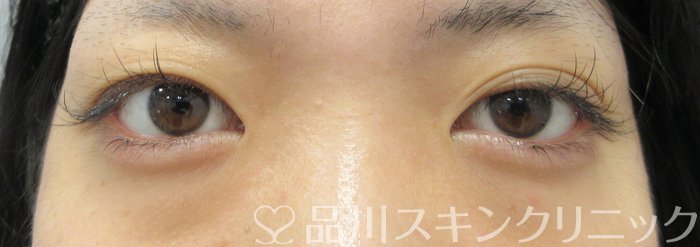 症例NO.74001のBEFORE写真