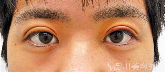 症例NO.52390のAFTER写真