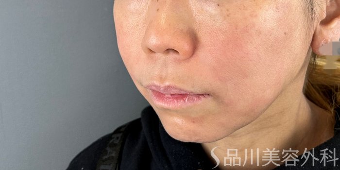 症例NO.72561のAFTER写真