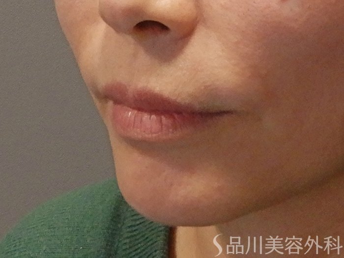 症例NO.69690のBEFORE写真