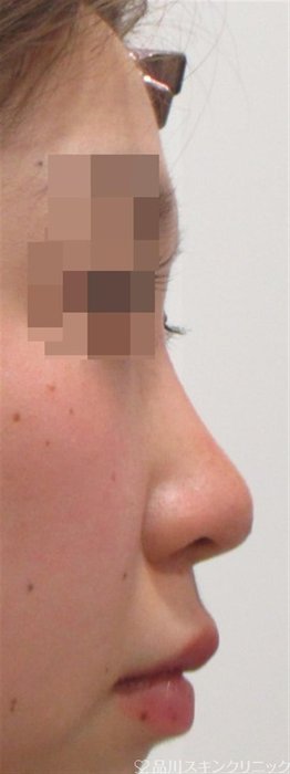 症例NO.27138のAFTER写真