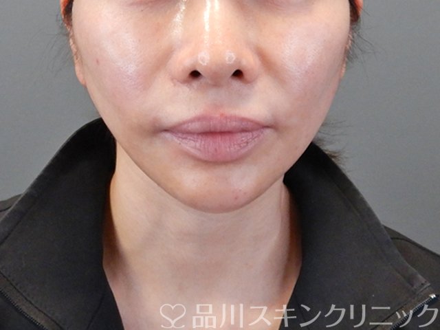 症例NO.68057のAFTER写真