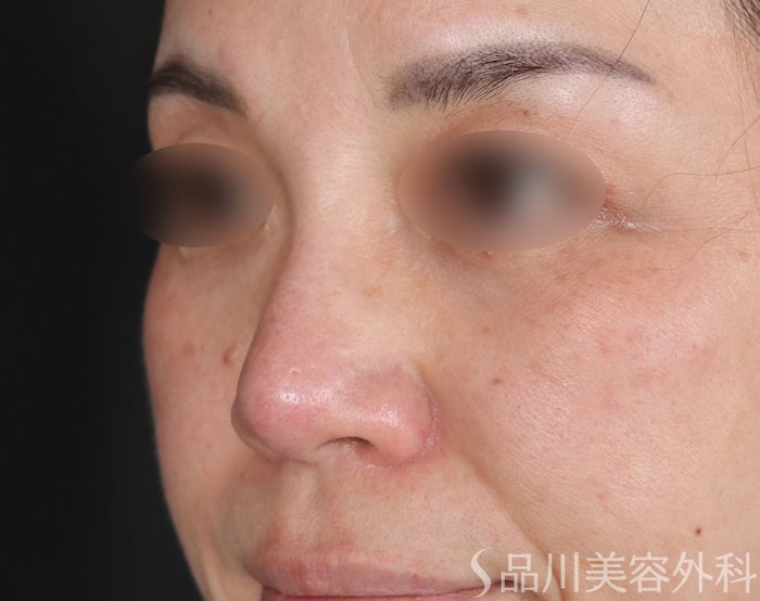 症例NO.73690のBEFORE写真