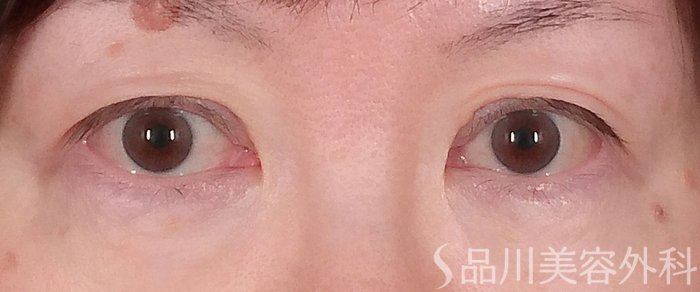 症例NO.70004のBEFORE写真