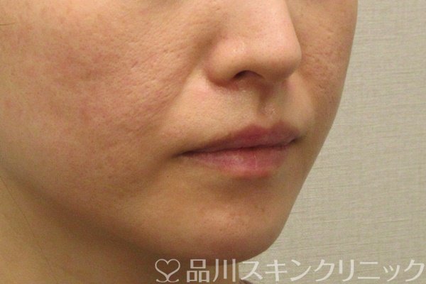 症例NO.72746のBEFORE写真