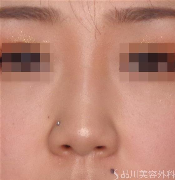 症例NO.52407のBEFORE写真
