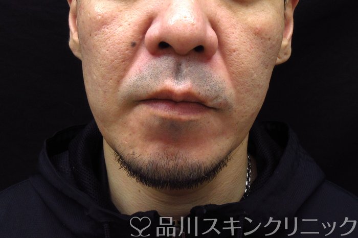 症例NO.74545のBEFORE写真