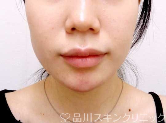 症例NO.69194のAFTER写真