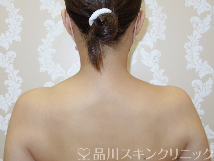 症例NO.73213のAFTER写真