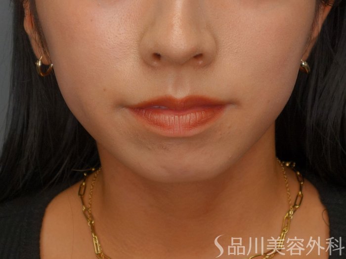 症例NO.74064のBEFORE写真