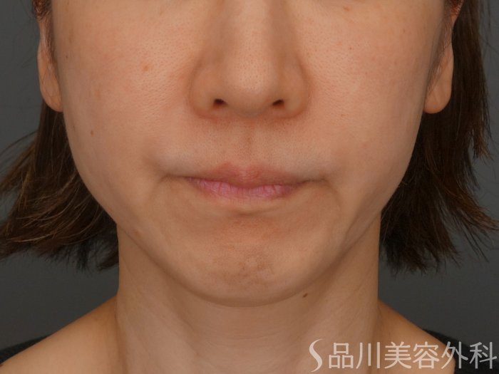 症例NO.64982のBEFORE写真