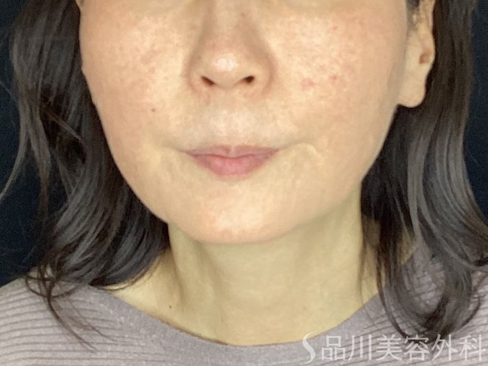 症例NO.67881のBEFORE写真