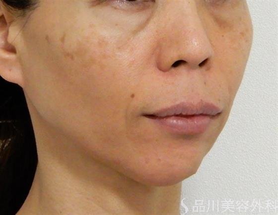 症例NO.39020のBEFORE写真