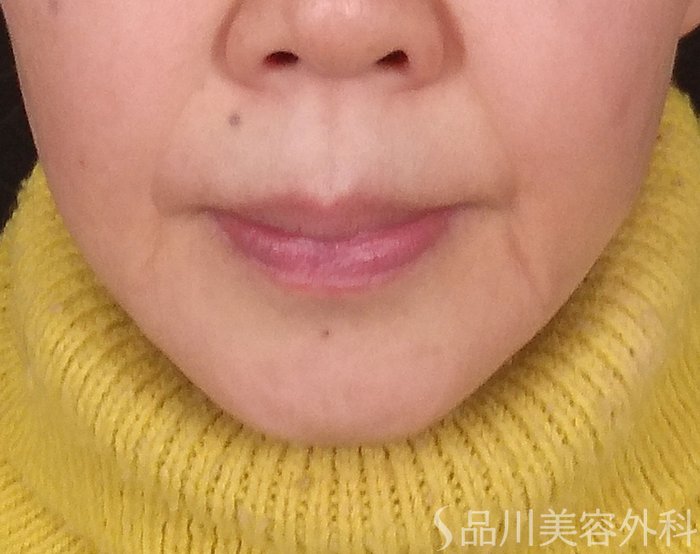 症例NO.69387のBEFORE写真
