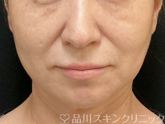 症例NO.74852のBEFORE写真