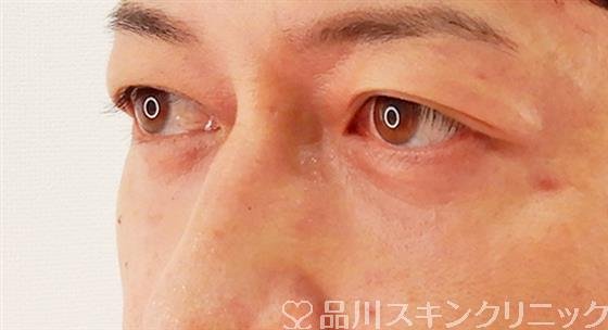 症例NO.61695のAFTER写真