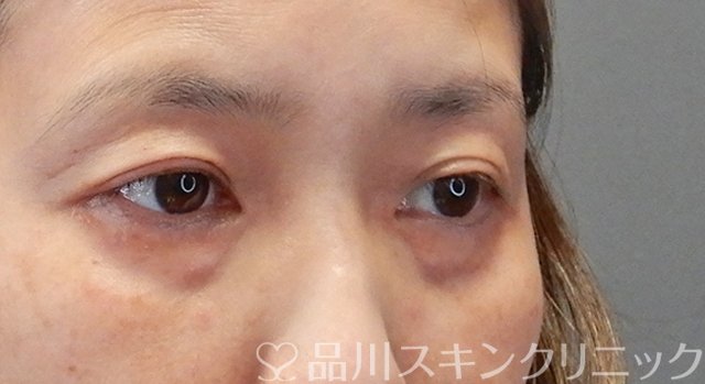 症例NO.75250のBEFORE写真